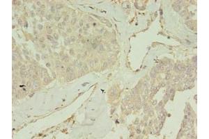 Immunohistochemistry of paraffin-embedded human endometrial cancer using ABIN7148088 at dilution of 1:100 (CCDC14 抗体  (AA 159-440))