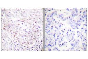 Immunohistochemistry analysis of paraffin-embedded human breast carcinoma tissue, using SENP3 antibody. (SENP3 抗体  (N-Term))