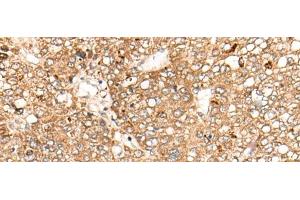 Immunohistochemistry of paraffin-embedded Human liver cancer tissue using C1S Polyclonal Antibody at dilution of 1:55(x200) (C1S 抗体)