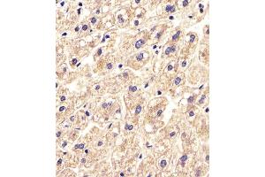 Antibody staining SLC16A11 in Human liver tissue sections by Immunohistochemistry (IHC-P - paraformaldehyde-fixed, paraffin-embedded sections). (SLC16A11 抗体  (N-Term))