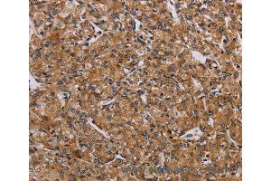 Immunohistochemistry of Human liver cancer using AATK Polyclonal Antibody at dilution of 1:45 (AATK 抗体)