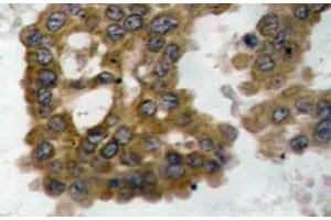 Immunohistochemistry (IHC) analyzes of p-Akt2 antibody in paraffin-embedded human lung carcinoma tissue. (AKT2 抗体  (pSer474))