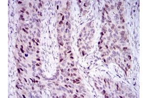 Immunohistochemical analysis of paraffin-embedded cervical cancer tissues using HDAC10 mouse mAb with DAB staining. (HDAC10 抗体  (AA 18-219))