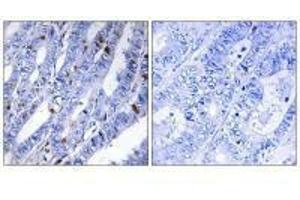 Immunohistochemistry analysis of paraffin-embedded human colon carcinoma tissue using PKA-R2β (Ab-113) antibody. (PRKAR2B 抗体  (Ser113))