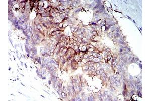 Immunohistochemical analysis of paraffin-embedded rectum cancer tissues using IGF1R-Beta mouse mAb with DAB staining. (IGF1R-beta (AA 1101-1367) 抗体)