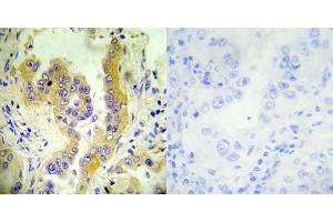 Immunohistochemical analysis of paraffin- embedded human lung carcinoma tissue using Tsc2 (Ab-1462) antibody (E022050). (Tuberin 抗体)