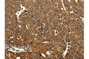 The image on the left is immunohistochemistry of paraffin-embedded Human ovarian cancer tissue using ABIN7129340(EIF2AK3 Antibody) at dilution 1/40, on the right is treated with fusion protein. (COQ3 抗体)