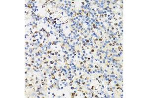 Immunohistochemistry of paraffin-embedded human appendicitis using SUMO4 Antibody. (SUMO4 抗体)
