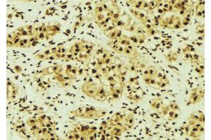 ABIN6268996 at 1/100 staining Human breast cancer tissue by IHC-P. (PRKACA 抗体  (Internal Region))