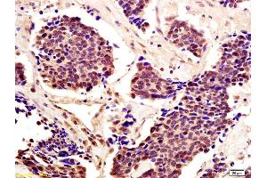 Formalin-fixed and paraffin embedded human lung carcinoma with labeled Anti-Cytomegalovirus pp65 Polyclonal Antibody, Unconjugated (ABIN738276) at 1:200, followed by conjugation to the secondary antibody and DAB staining (STAT5A 抗体  (AA 61-160))