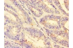 Immunohistochemistry of paraffin-embedded human endometrial cancer using ABIN7142866 at dilution of 1:100 (MMP2 抗体  (AA 445-660))