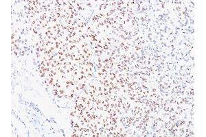 Formalin-fixed, paraffin-embedded human Melanoma stained with MITF Mouse Monoclonal Antibody (D5).