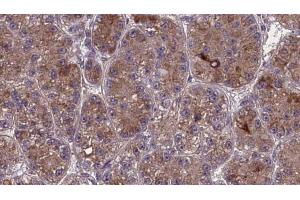 ABIN6273981 at 1/100 staining Human liver cancer tissue by IHC-P. (OR2S2 抗体  (C-Term))