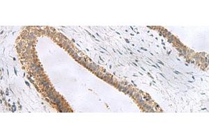 Immunohistochemistry of paraffin-embedded Human breast cancer tissue using CEMIP Polyclonal Antibody at dilution of 1:120(x200) (CEMIP 抗体)