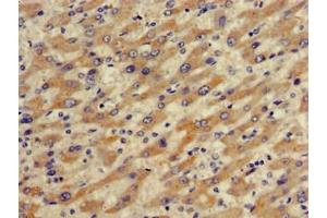 Immunohistochemistry of paraffin-embedded human liver cancer using ABIN7170287 at dilution of 1:100 (SLCO1B1 抗体  (AA 426-537))