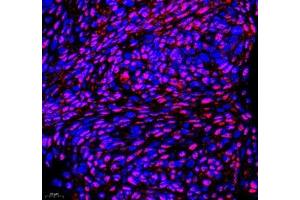 Immunofluorescence of paraffin embedded human cervical cancer using PABPN1 (ABIN7075116) at dilution of 1:600 (400x lens) (PABPN1 抗体)