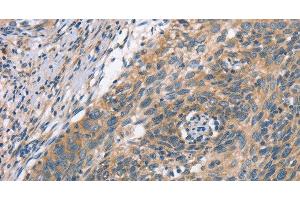 Immunohistochemistry of paraffin-embedded Human cervical cancer using PLEKHO1 Polyclonal Antibody at dilution of 1:70 (PLEKHO1 抗体)
