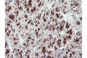 Immunohistochemical staining of paraffin-embedded Carcinoma of Human liver tissue using anti-GOLM1 mouse monoclonal antibody. (GOLM1 抗体)