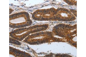 Immunohistochemistry of Human lung cancer using PDCD7 Polyclonal Antibody at dilution of 1:60 (PDCD7 抗体)