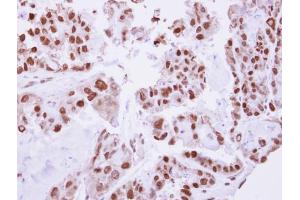 IHC-P Image Immunohistochemical analysis of paraffin-embedded human ovarian cancer, using C/EBP beta, antibody at 1:250 dilution. (CEBPB 抗体  (N-Term))