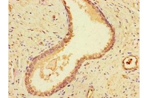 Immunohistochemistry of paraffin-embedded human prostate cancer using ABIN7149795 at dilution of 1:100 (Destrin 抗体  (AA 2-165))