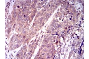 Immunohistochemical analysis of paraffin-embedded bladder cancer tissues using KEAP1 mouse mAb with DAB staining. (KEAP1 抗体  (AA 380-624))