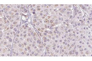 ABIN6276810 at 1/100 staining Human melanoma tissue by IHC-P. (PEDF 抗体  (C-Term))