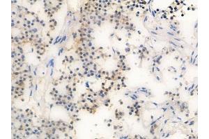 ABIN6257307 and ABIN6274300 at 1/100 staining human pituitary adenoma by IHC-P. (LMO4 抗体  (C-Term))