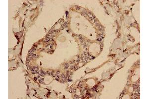Immunohistochemistry analysis of human pancreatic cancer using ABIN7147768 at dilution of 1:100 (CFAP61 抗体  (AA 1-200))