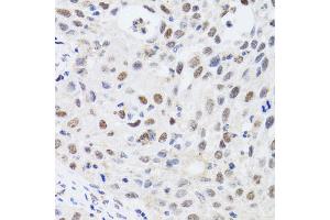 Immunohistochemistry of paraffin-embedded human lung cancer using CBX4 antibody. (CBX4 抗体)