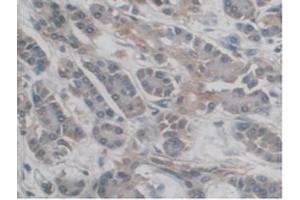 IHC-P analysis of Human Pancreas Cancer Tissue, with DAB staining. (DC-SIGN/CD209 抗体  (AA 70-404))
