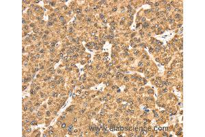 Immunohistochemistry of Human liver cancer using RRBP1 Polyclonal Antibody at dilution of 1:25 (RRBP1 抗体)