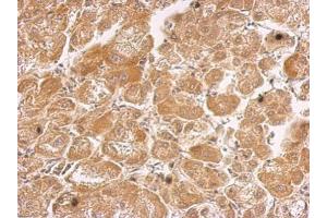 IHC-P Image HHIP antibody [N3C2], Internal detects HHIP protein at cytosol on human hepatoma by immunohistochemical analysis. (HHIP 抗体)