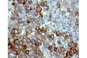 Formalin-fixed, paraffin-embedded human melanoma stained with NGFR antibody (NTR/912). (NGFR 抗体)