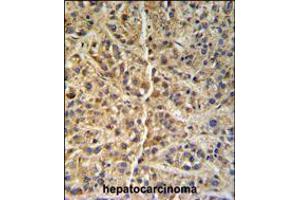 GNS Antibody (Center S298) IHC analysis in formalin fixed and paraffin embedded human hepatocarcinoma followed by peroxidase conjugation of the secondary antibody and DAB staining. (GNS 抗体  (AA 283-313))