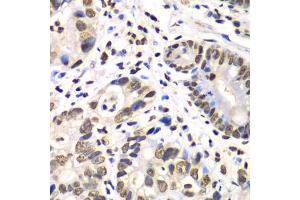 Immunohistochemistry of paraffin-embedded human gastric cancer using RBBP7 antibody (ABIN6290864) at dilution of 1:100 (40x lens). (RBBP7 抗体)