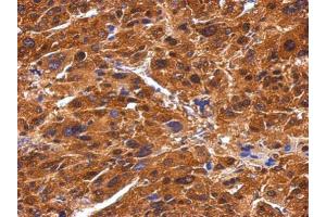 IHC-P Image Immunohistochemical analysis of paraffin-embedded human hepatoma, using BIVM, antibody at 1:500 dilution. (BIVM 抗体  (C-Term))