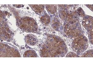ABIN6277718 at 1/100 staining Human liver cancer tissue by IHC-P. (Occludin 抗体)