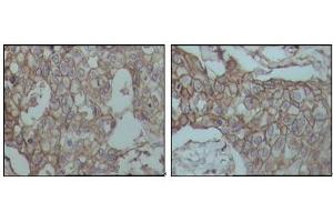 Immunohistochemical analysis of paraffin-embedded human breast carcinoma tissues, showing membrane localization with DAB staining using CD44 mouse mAb. (CD44 抗体)