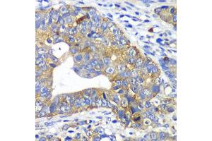 Immunohistochemistry of paraffin-embedded human gastric cancer using ARFGAP1 antibody at dilution of 1:100 (x40 lens). (ARFGAP1 抗体)