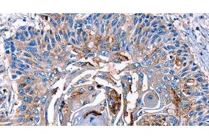 Immunohistochemistry of paraffin-embedded Human esophagus cancer tissue using LRP2 Polyclonal Antibody at dilution 1:40 (LRP2 抗体)