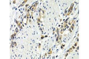 Immunohistochemistry of paraffin-embedded Human gastric cancer using WNT3A Polyclonal Antibody at dilution of 1:200 (40x lens). (WNT3A 抗体)