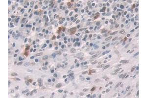 DAB staining on IHC-P; Samples: Human Colorectal cancer Tissue (Glucocorticoid Receptor 抗体  (AA 532-730))