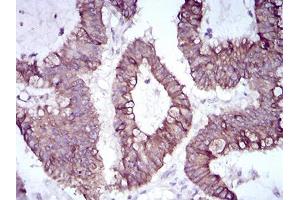 Immunohistochemical analysis of paraffin-embedded colon cancer tissues using SNAI2 mouse mAb with DAB staining. (SLUG 抗体  (AA 100-200))