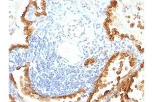 Formalin-fixed, paraffin-embedded human lung carcinoma stained with Cytokeratin 8 + 18 antibody (KRT8/803 + KRT18/835). (Cytokeratin 8/18 抗体)