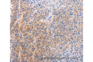 Immunohistochemistry of Human cervical cancer using ADHFE1 Polyclonal Antibody at dilution of 1:60 (ADHFE1 抗体)