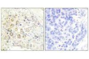 Immunohistochemistry analysis of paraffin-embedded human breast carcinoma tissue using HER3 antibody. (ERBB3 抗体  (N-Term))
