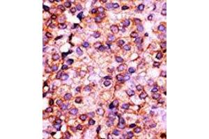 Formalin-fixed and paraffin-embedded human cancer tissue reacted with the primary antibody, which was peroxidase-conjugated to the secondary antibody, followed by AEC staining. (PANK3 抗体  (N-Term))