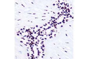 Immunohistochemistry of paraffin-embedded Human breast cancer using TriMethyl-Histone H3-K36 Rabbit pAb (ABIN3016038, ABIN3016039, ABIN3016040, ABIN1680217 and ABIN6219525) at dilution of 1:100 (40x lens). (Histone 3 抗体  (H3K36me3))