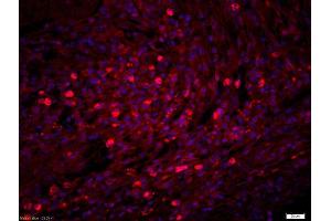 Formalin-fixed and paraffin-embedded human lung carcinoma labeled with Rabbit Anti-NCR1 Polyclonal Antibody, Unconjugatedused at 1:200 dilution for 40 minutes at 37°C. (NCR1 抗体  (AA 198-206))